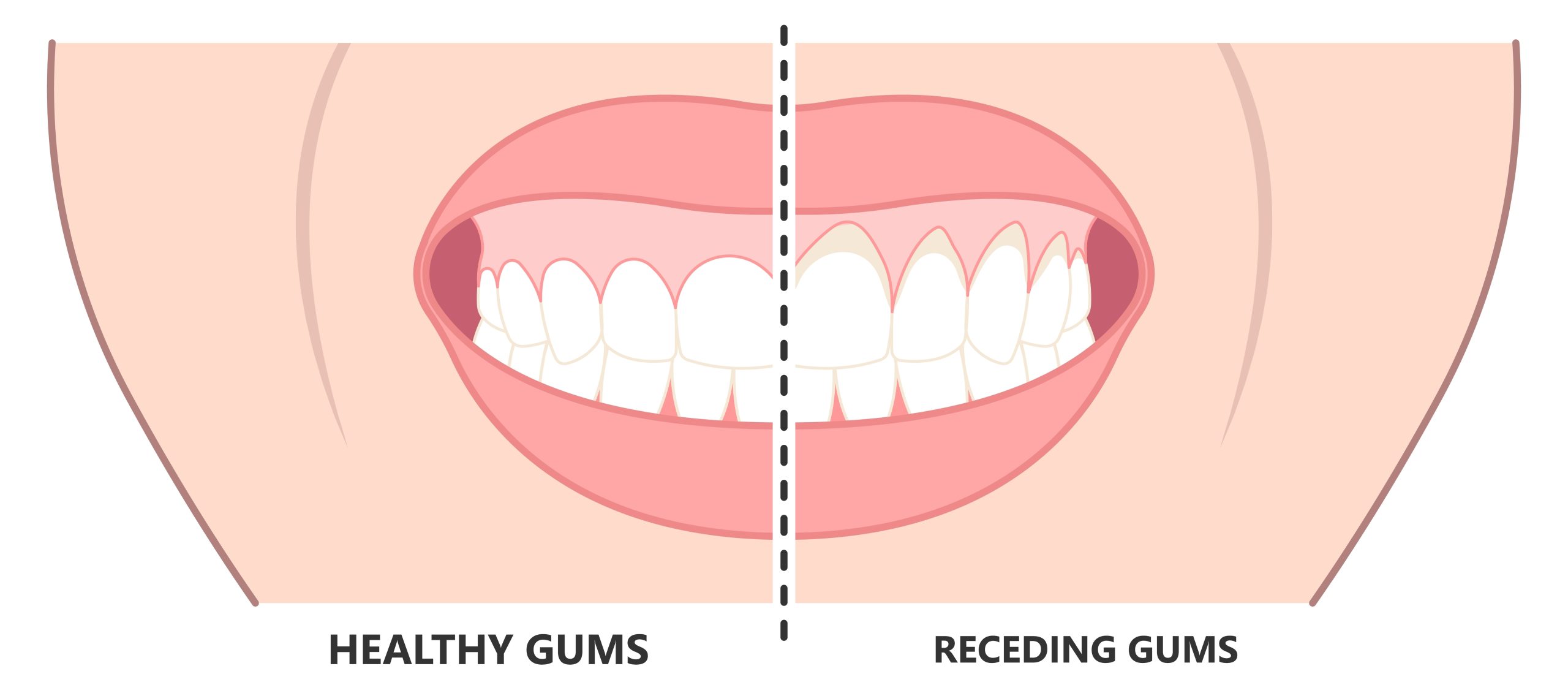 Dip Gum Disease, Tooth Loss, and Other Effects