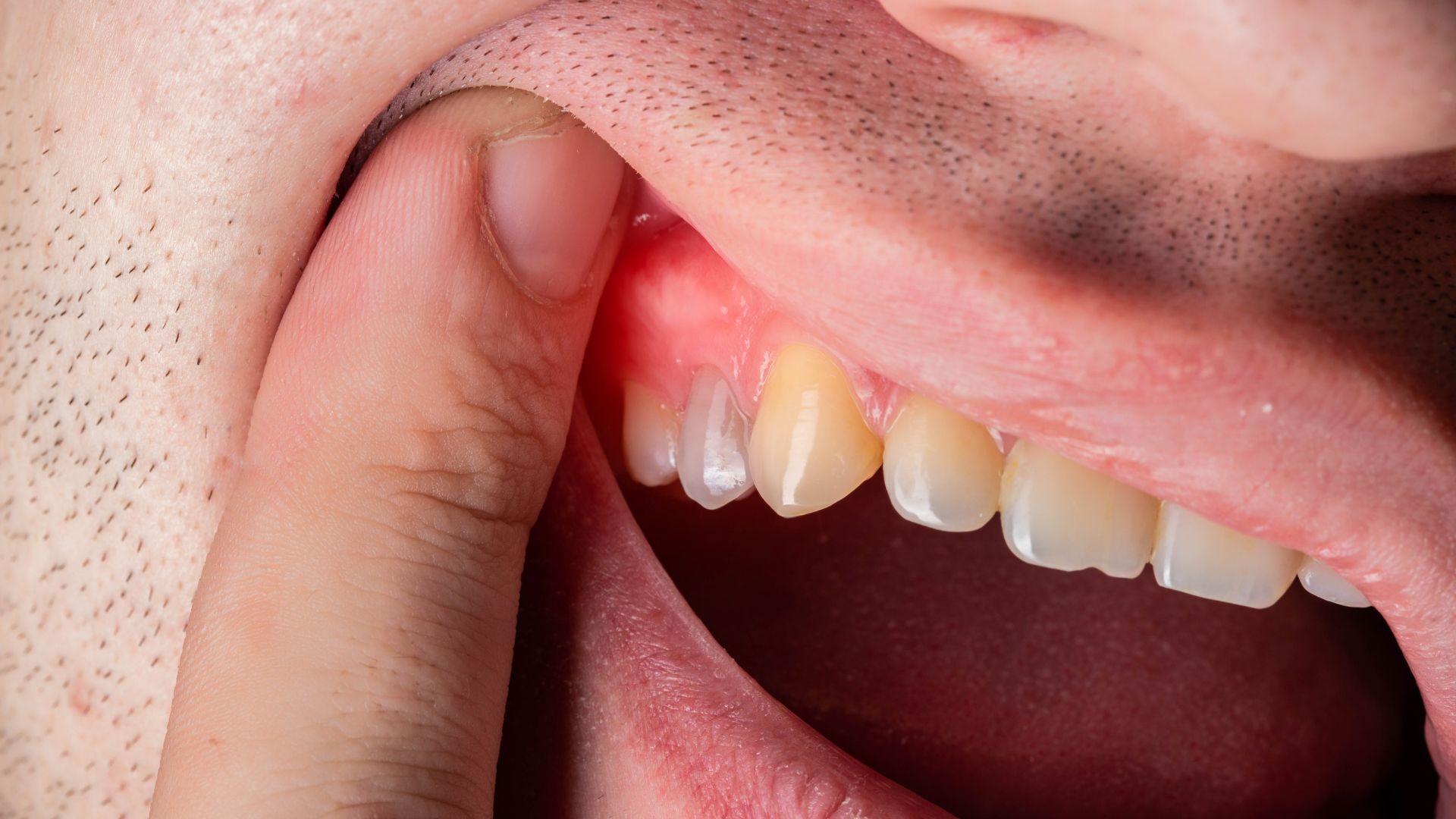 Dip Gum Disease, Tooth Loss, and Other Effects