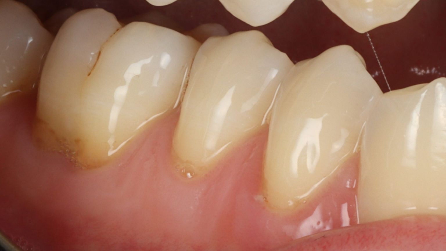 The Best Home Treatments for Exposed Tooth Roots - GDG