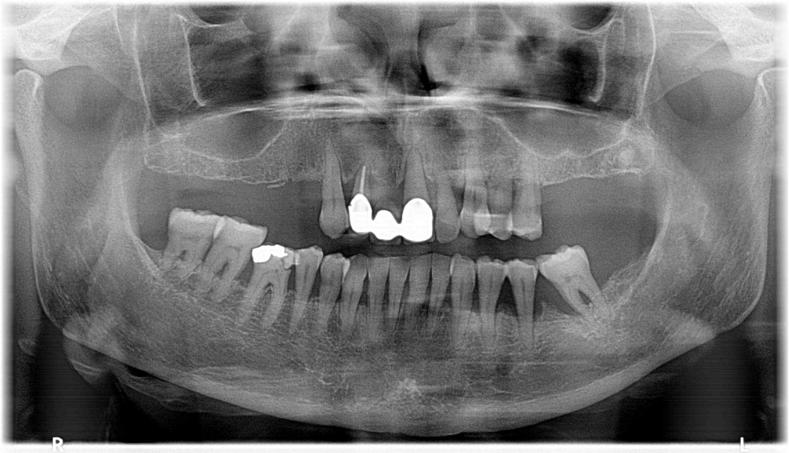 How Do Dentists Treat Gingivitis