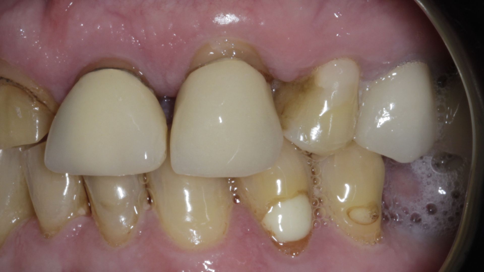 Do Gums Recede With Age?